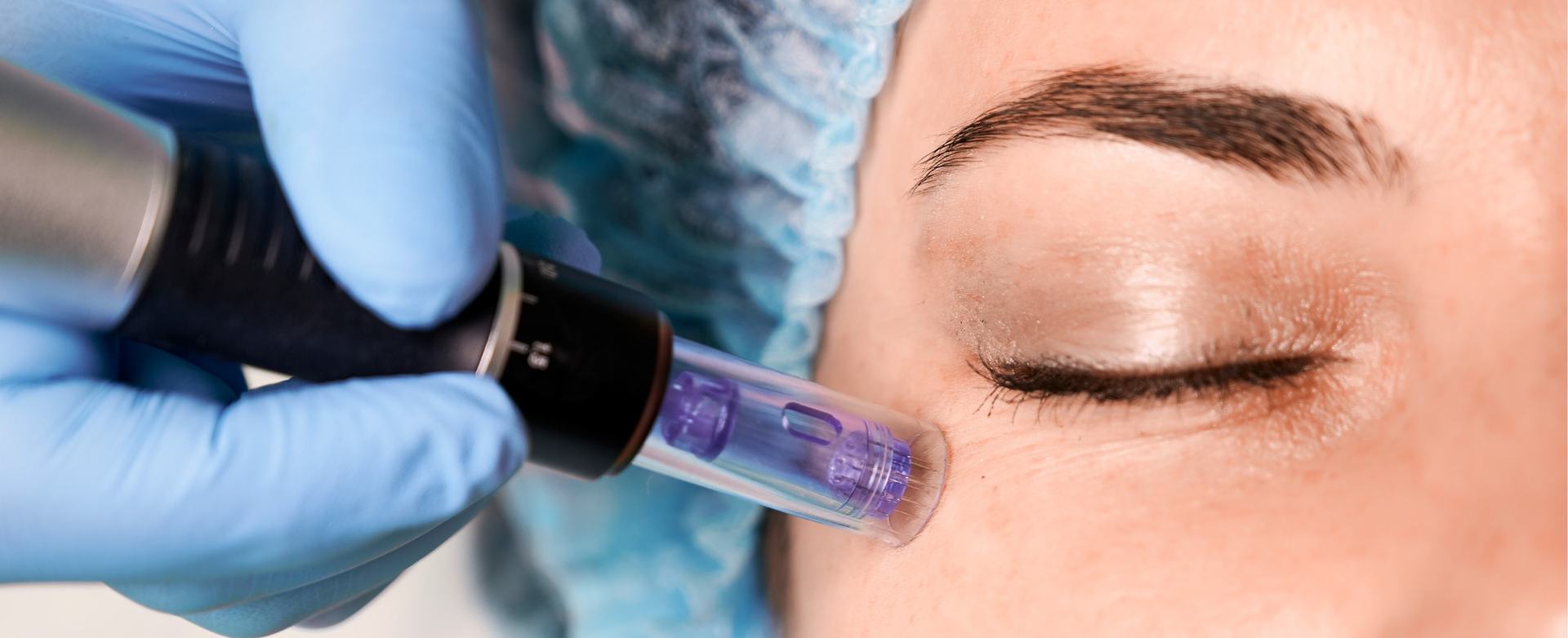 DERMAPEN FACIAL en Espai Vital