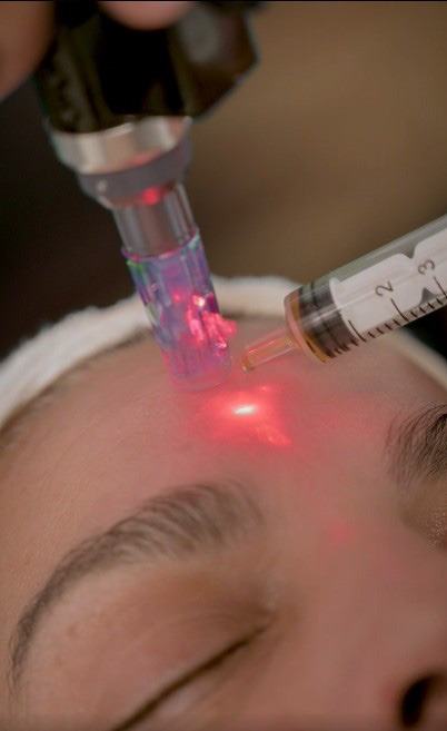 Microneedling exosomas - Dermapen en Espai Vital