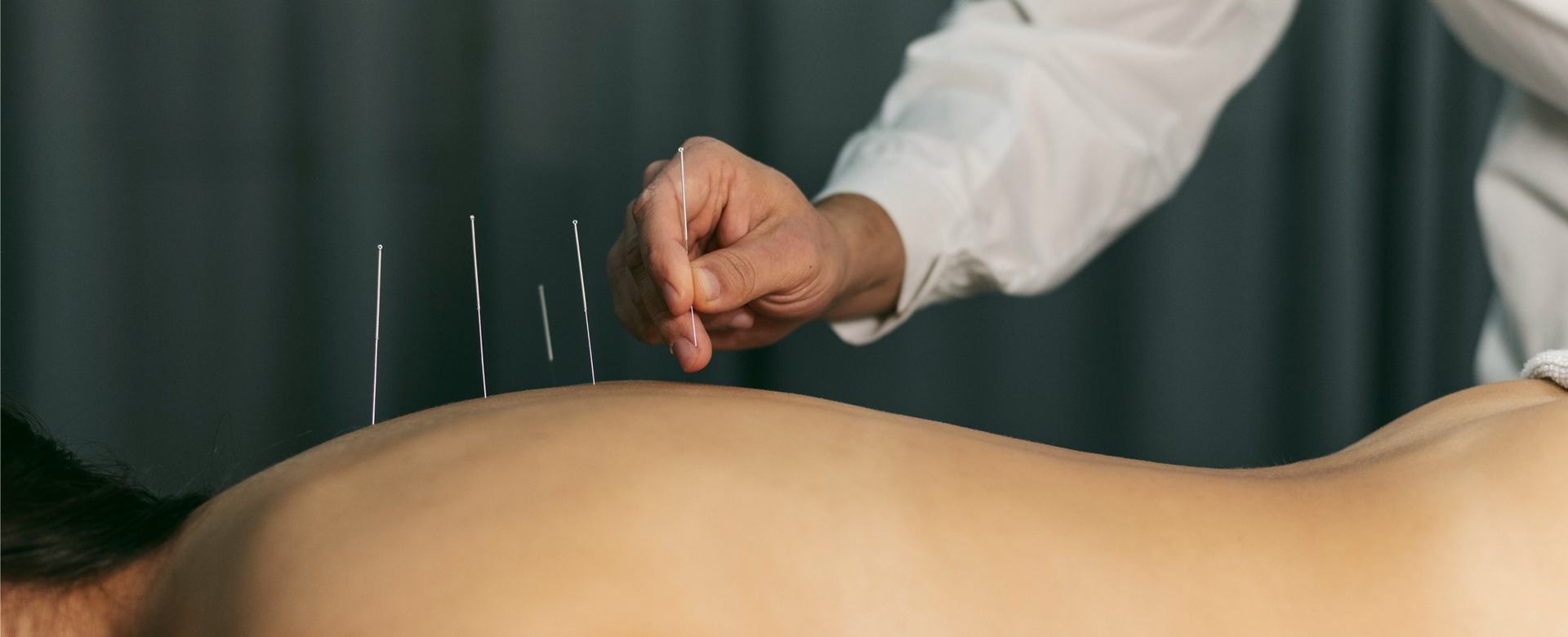 Acupuntura en Espai Vital